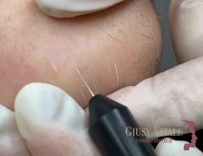 Trattamento di elettrocoagulazione per eliminare i peli bianchi su viso e corpo