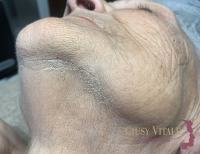 Trattamento viso per ispessimento cutaneo e pelle spessa