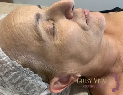 Trattamento viso anti-age per pelle matura con rughe e rilassamento cutaneo