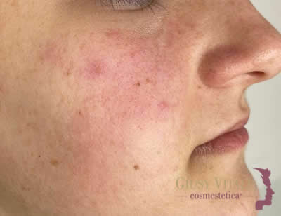 Trattamento viso per pelle sensibile, secca e disidratata