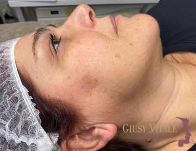 Trattamento viso per pelle spenta e con macchie, schiarente e illuminante