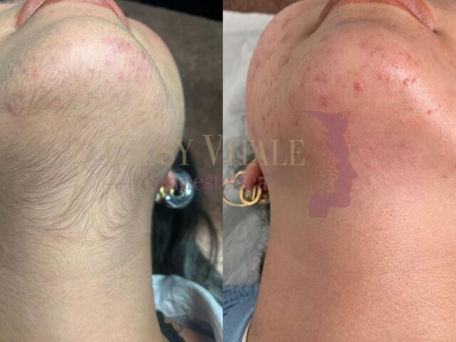 Confronto prima e dopo epilazione mento e collo donna