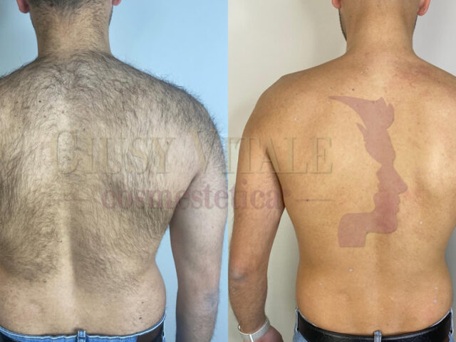 Confronto prima e dopo epilazione definitiva schiena uomo