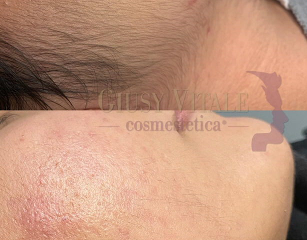 Confronto prima e dopo epilazione viso donna