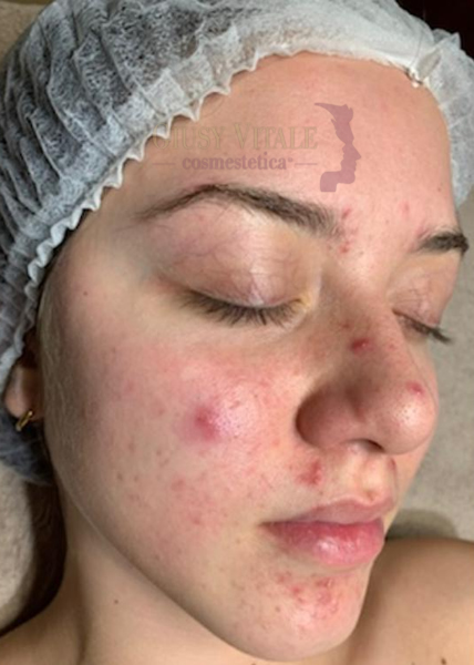 Trattamento viso anti-acne professionale presso il centro estetico Giusy Vitale