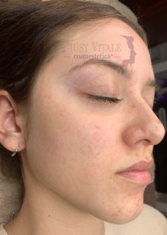 Pelle sana, luminosa e uniforme dopo il trattamento acne